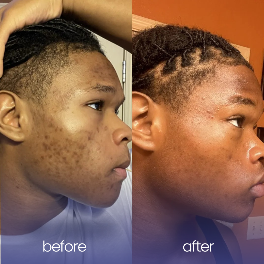 Turmeric & Kojic Acid Pads